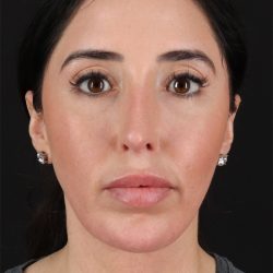 Fat Grafting To The Face Before & After Patient #11783