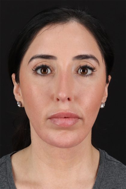 Fat Grafting To The Face Before & After Patient #11783