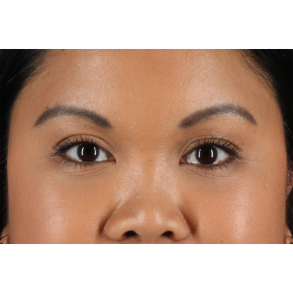 Brow Lift Before & After Patient #11646