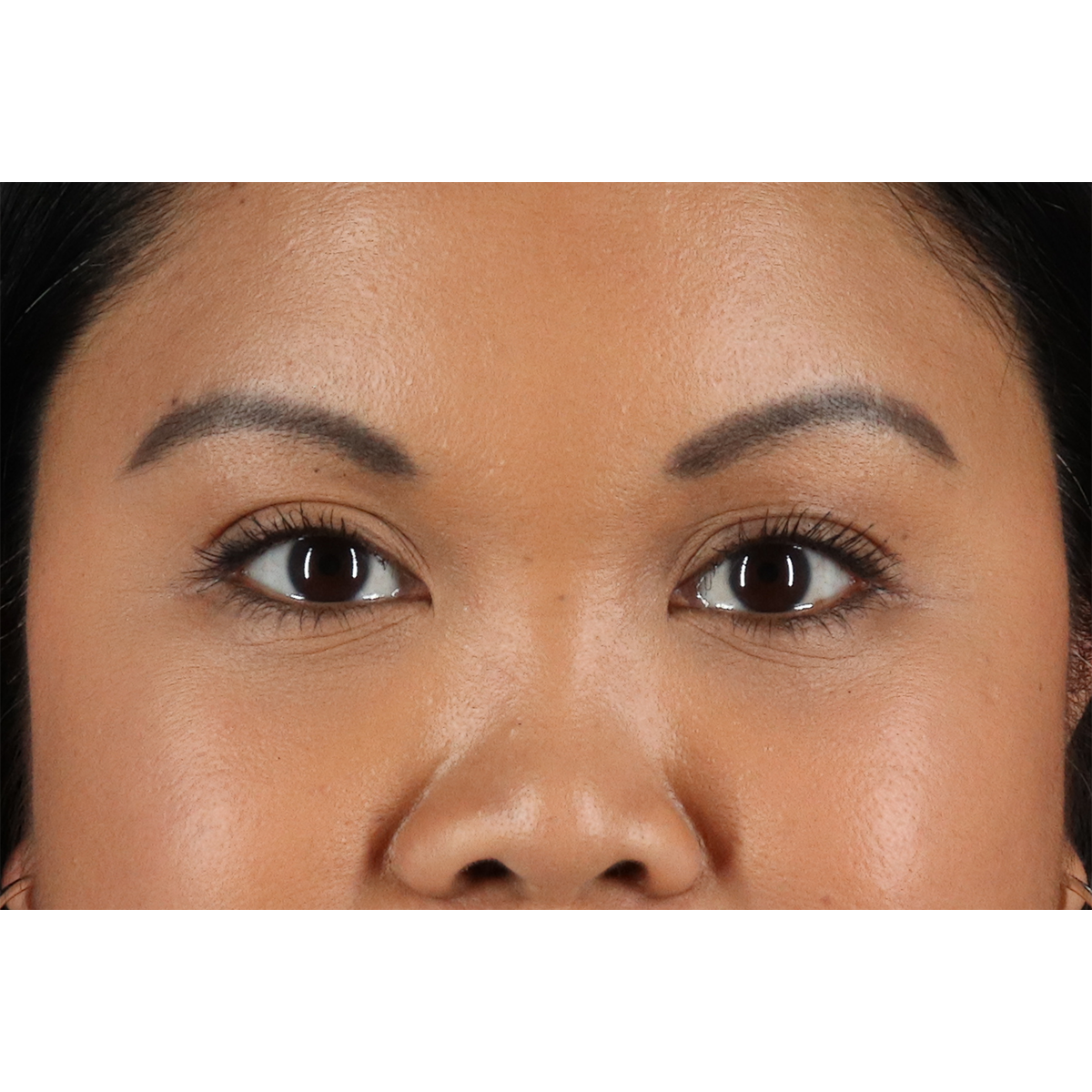 Brow Lift Before & After Patient #11646