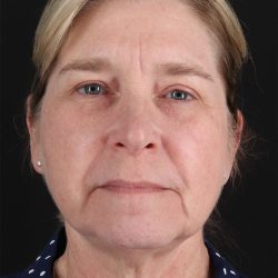CO2 Laser Before & After Patient #11191
