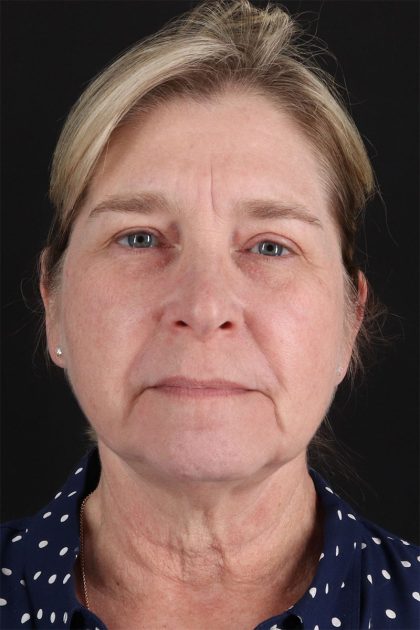 CO2 Laser Before & After Patient #11191