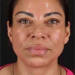 CO2 Laser Before & After Patient #11719