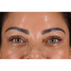 Blepharoplasty (Eyelid Surgery) Before & After Patient #11348