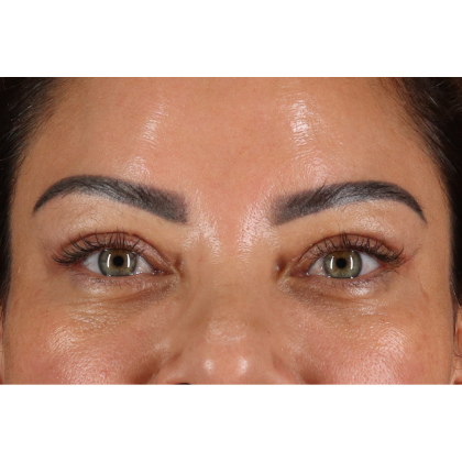 Blepharoplasty (Eyelid Surgery) Before & After Patient #11348