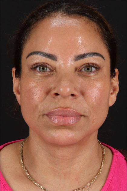 CO2 Laser Before & After Patient #11719