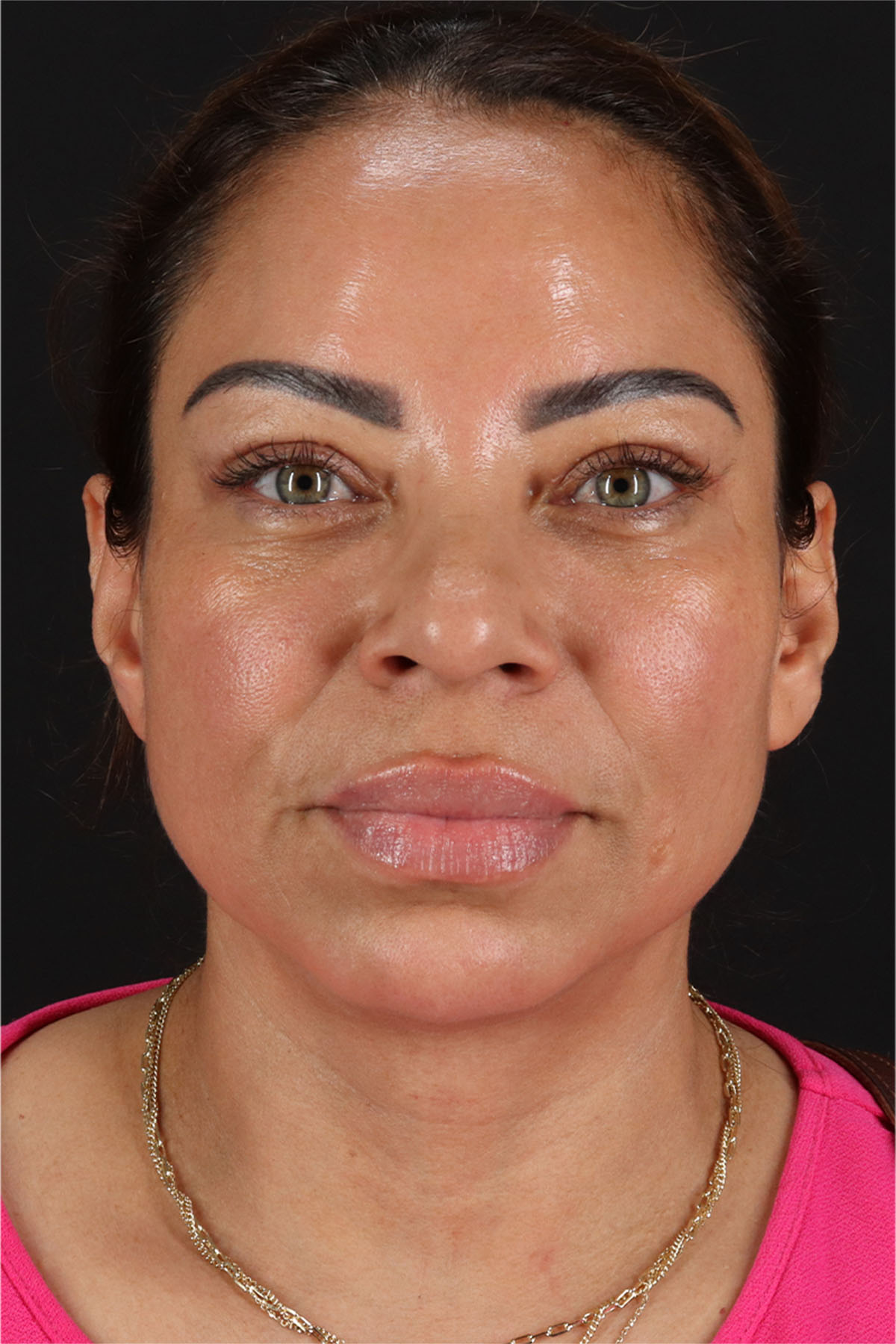 CO2 Laser Before & After Patient #11719
