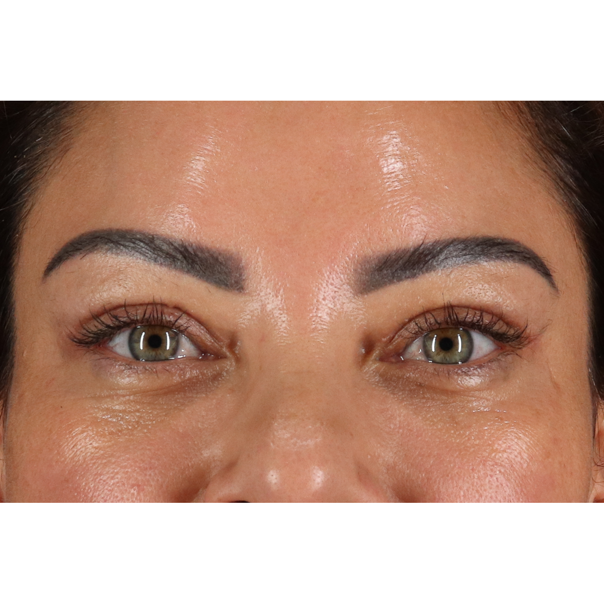 Blepharoplasty (Eyelid Surgery) Before & After Patient #11348