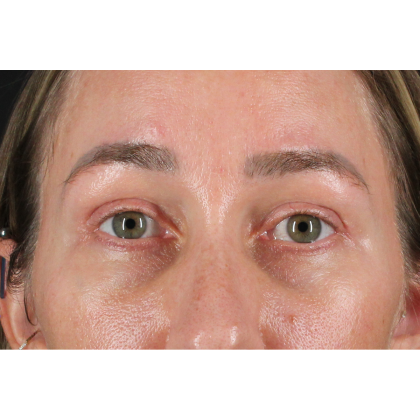 Blepharoplasty (Eyelid Surgery) Before & After Patient #11585