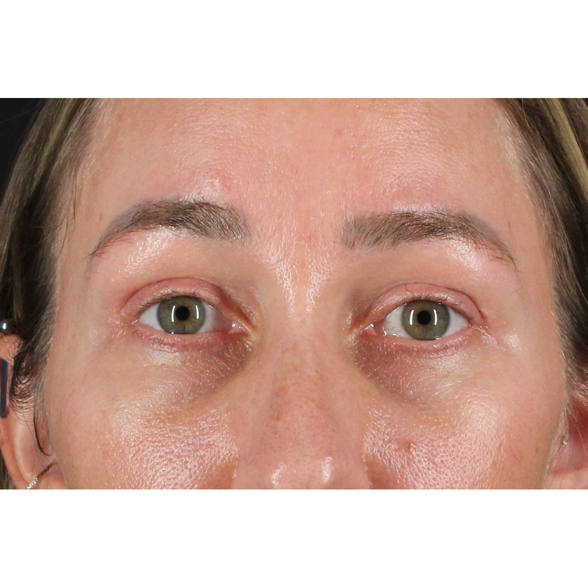 Blepharoplasty (Eyelid Surgery) Before & After Patient #11585