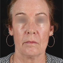 CO2 Laser Before & After Patient #11385