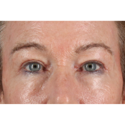 Blepharoplasty (Eyelid Surgery) Before & After Patient #11404