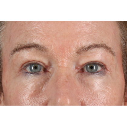 Blepharoplasty (Eyelid Surgery) Before & After Patient #11404