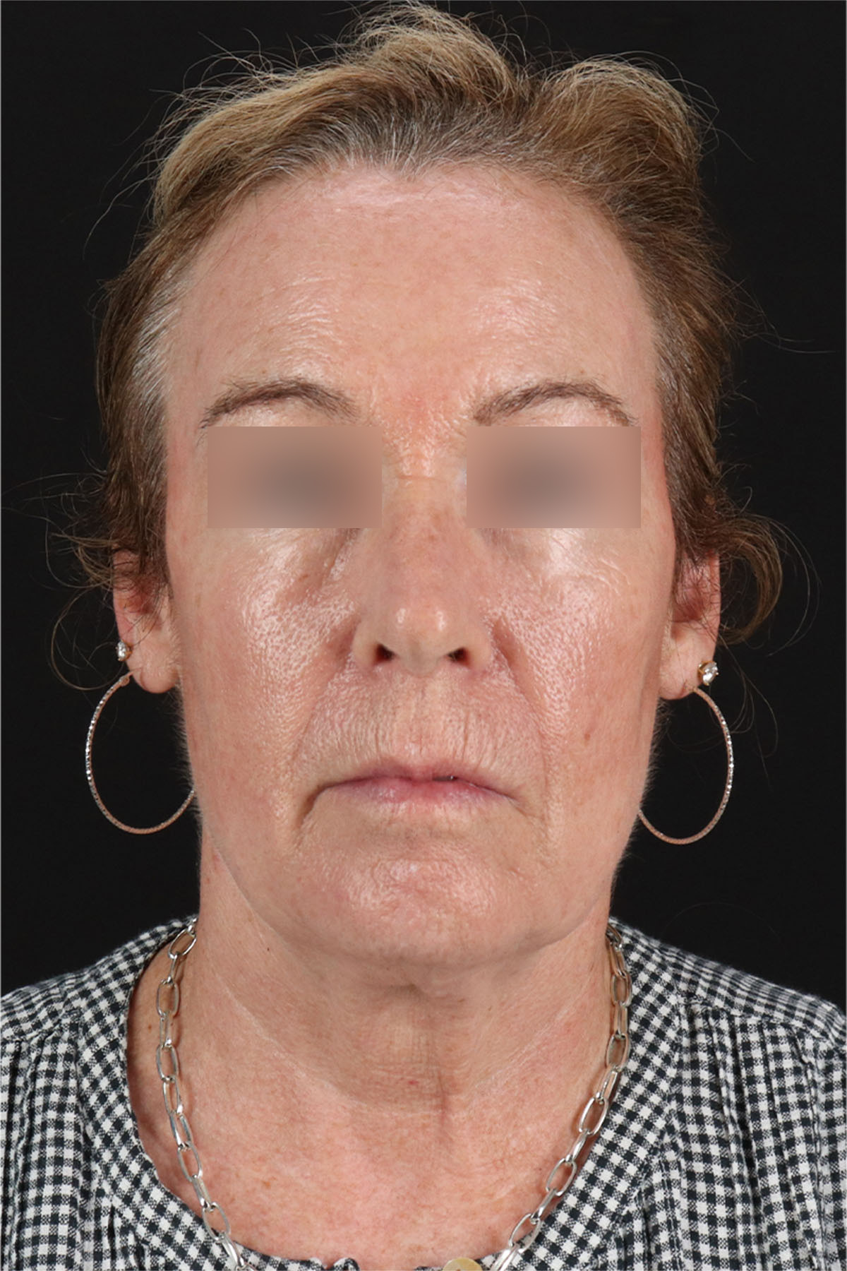 CO2 Laser Before & After Patient #11385
