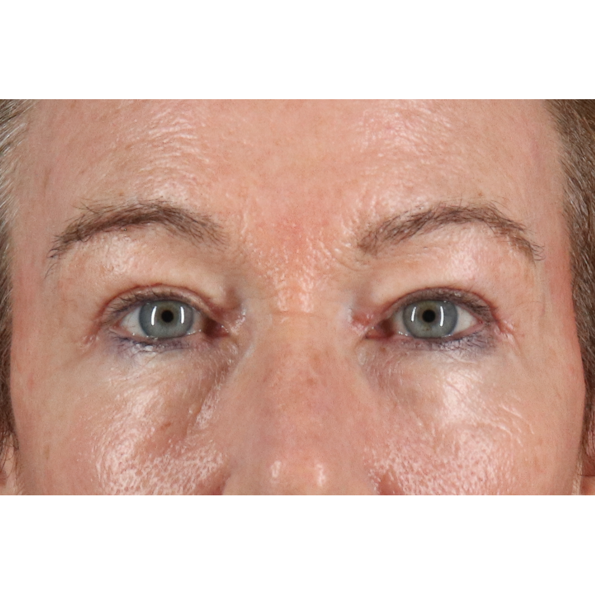 Blepharoplasty (Eyelid Surgery) Before & After Patient #11404