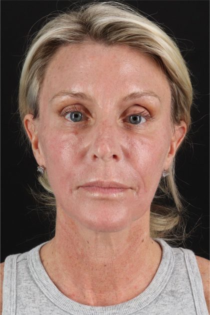 Fat Grafting To The Face Before & After Patient #11753
