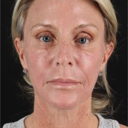 Facelift Before & After Patient #11682