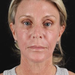 CO2 Laser Before & After Patient #11202