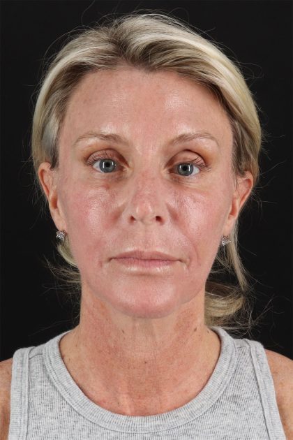 CO2 Laser Before & After Patient #11202