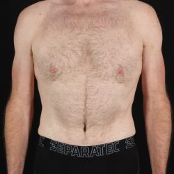 Quantum RF Before & After Patient #9985