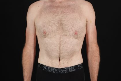 Quantum RF Before & After Patient #9985