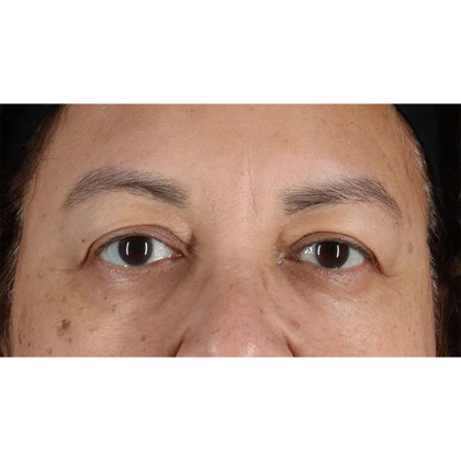 Blepharoplasty (Eyelid Surgery) Before & After Patient #10595