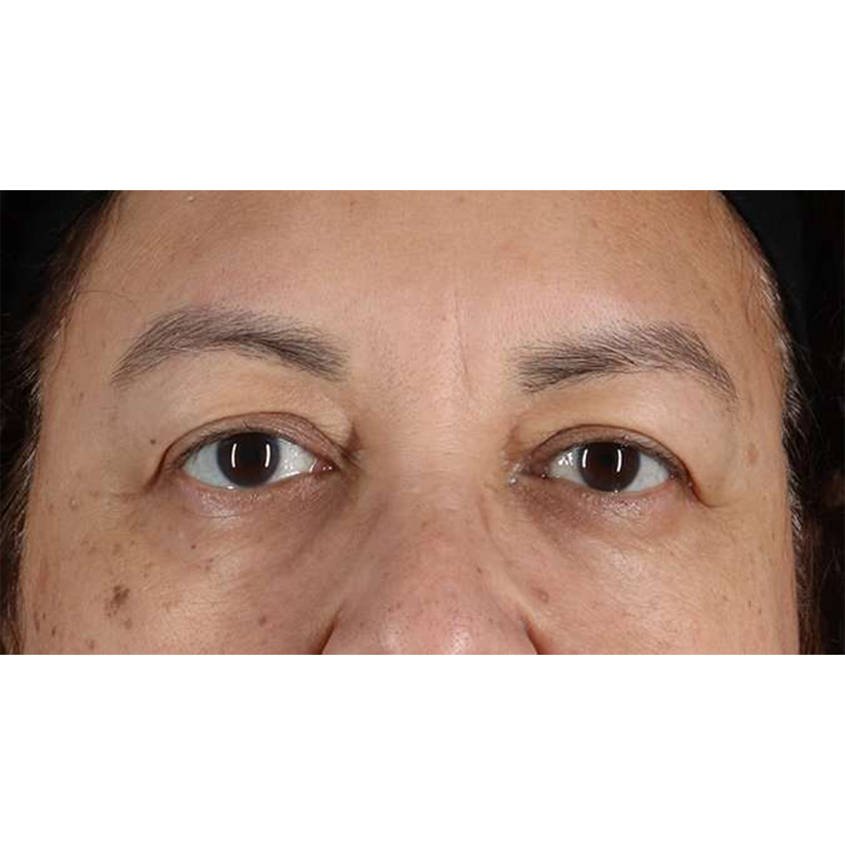 Blepharoplasty (Eyelid Surgery) Before & After Patient #10595