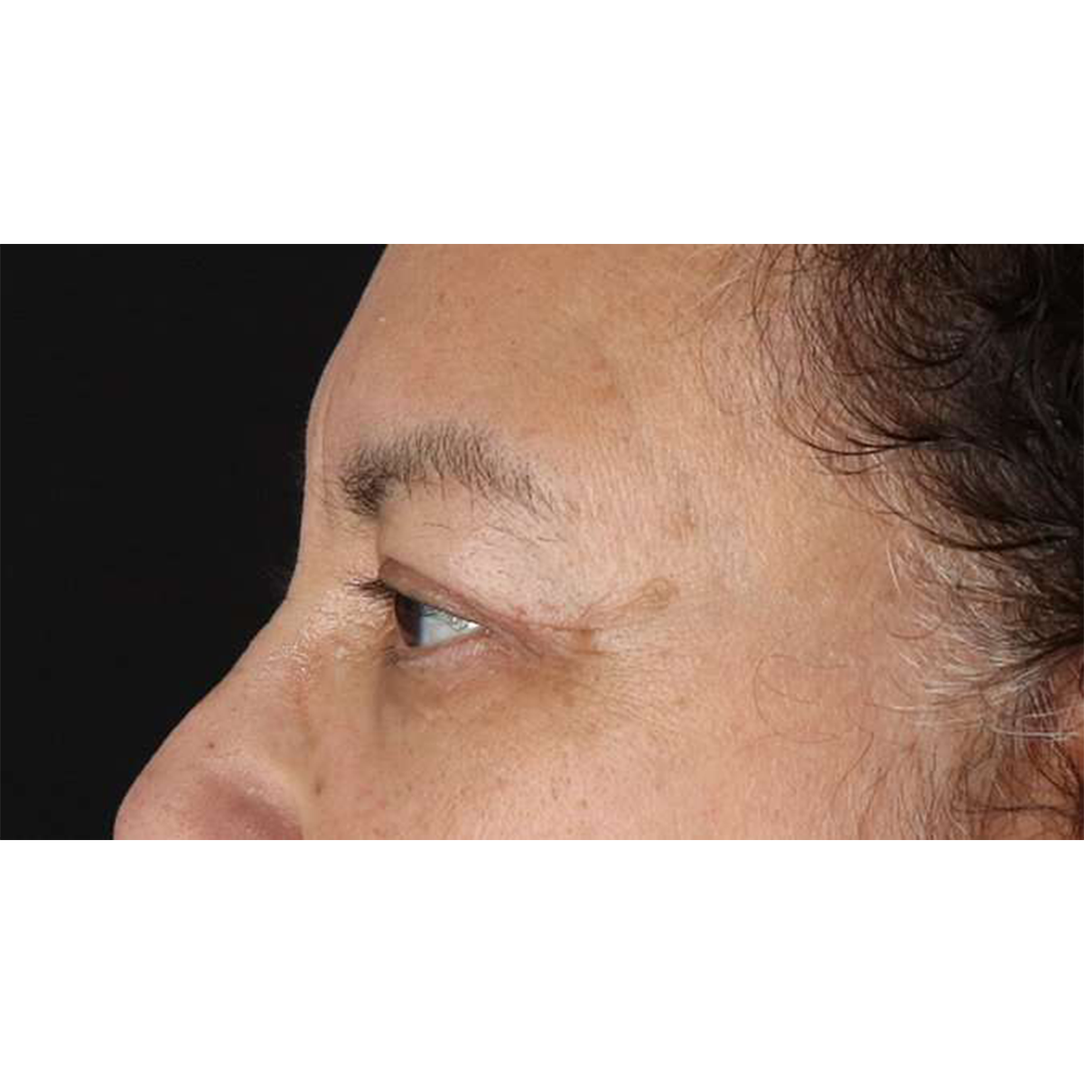 Blepharoplasty (Eyelid Surgery) Before & After Patient #10595