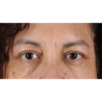 Blepharoplasty (Eyelid Surgery) Before & After Patient #10595