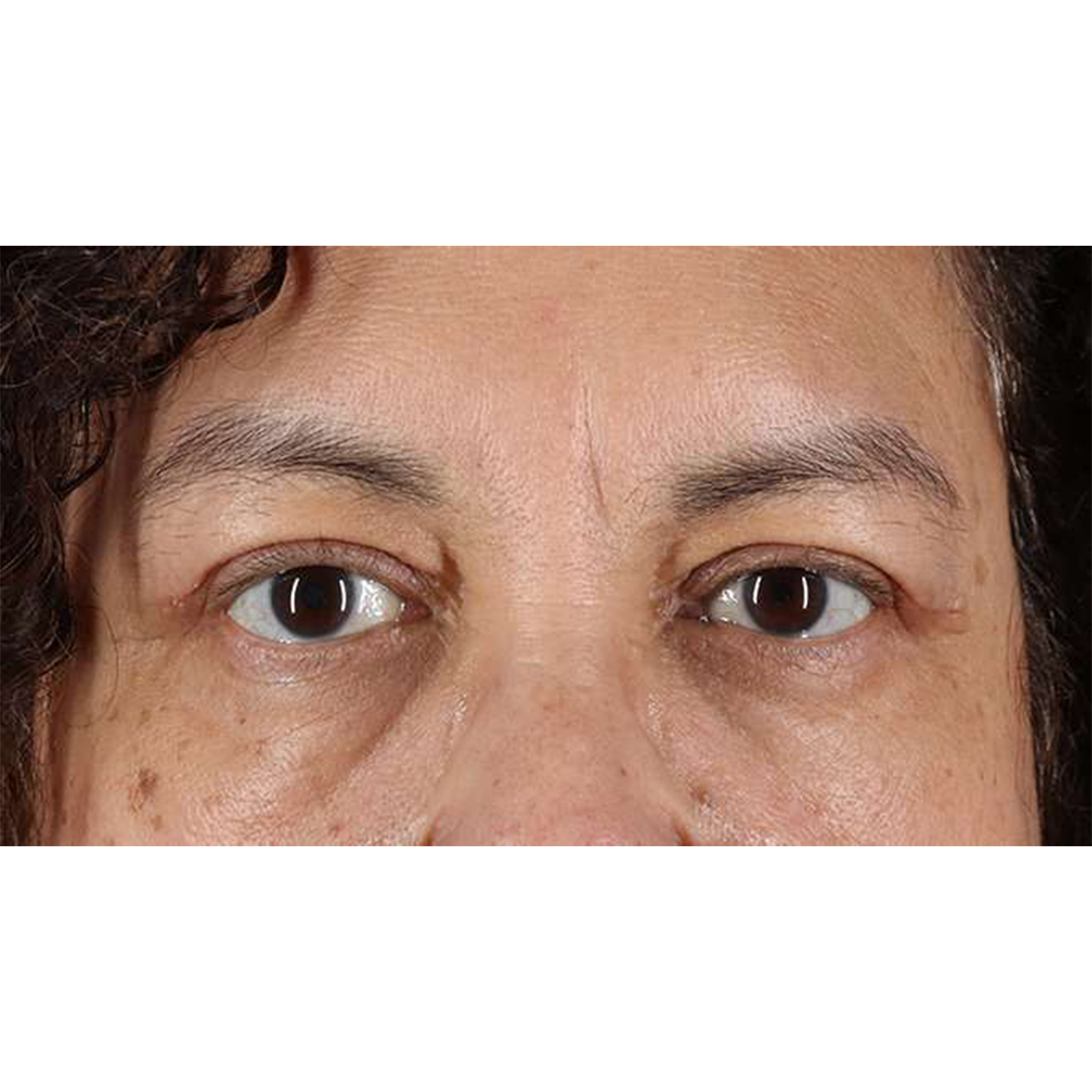 Blepharoplasty (Eyelid Surgery) Before & After Patient #10595