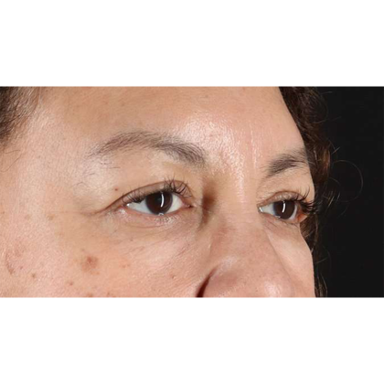 Blepharoplasty (Eyelid Surgery) Before & After Patient #10595