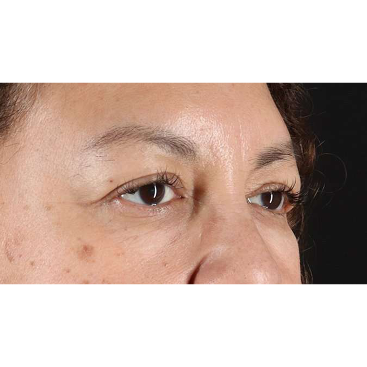 Blepharoplasty (Eyelid Surgery) Before & After Patient #10595