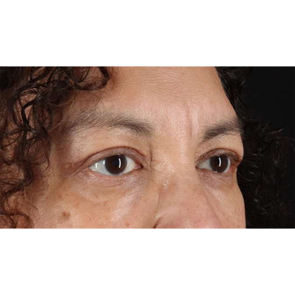 Blepharoplasty (Eyelid Surgery) Before & After Patient #10595