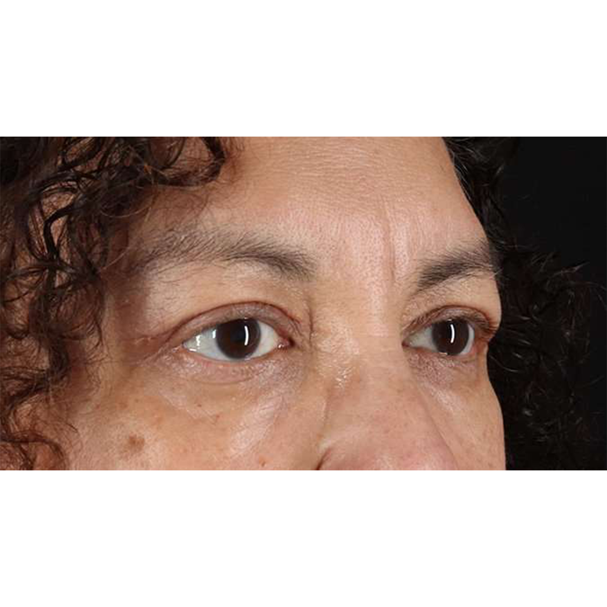 Blepharoplasty (Eyelid Surgery) Before & After Patient #10595