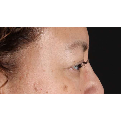 Blepharoplasty (Eyelid Surgery) Before & After Patient #10595