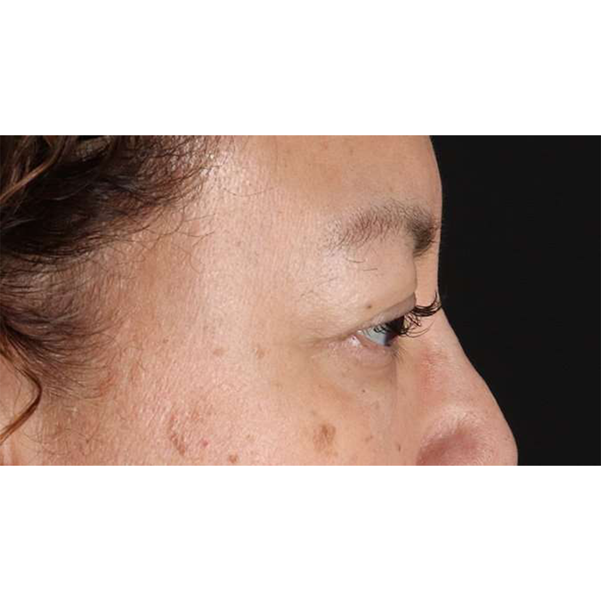 Blepharoplasty (Eyelid Surgery) Before & After Patient #10595