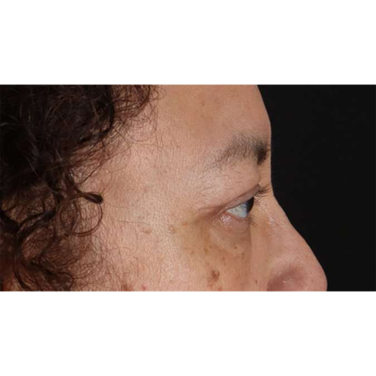Blepharoplasty (Eyelid Surgery) Before & After Patient #10595