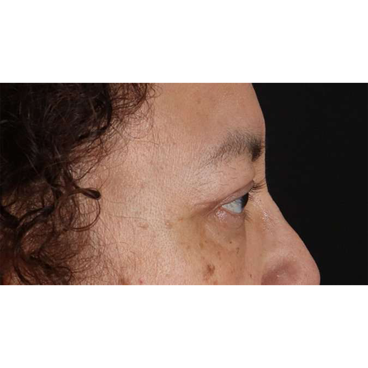 Blepharoplasty (Eyelid Surgery) Before & After Patient #10595