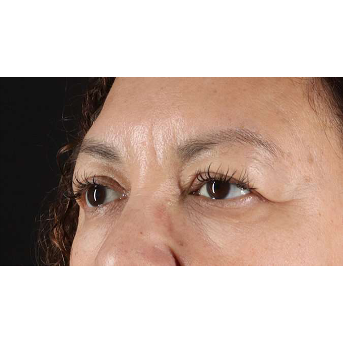 Blepharoplasty (Eyelid Surgery) Before & After Patient #10595