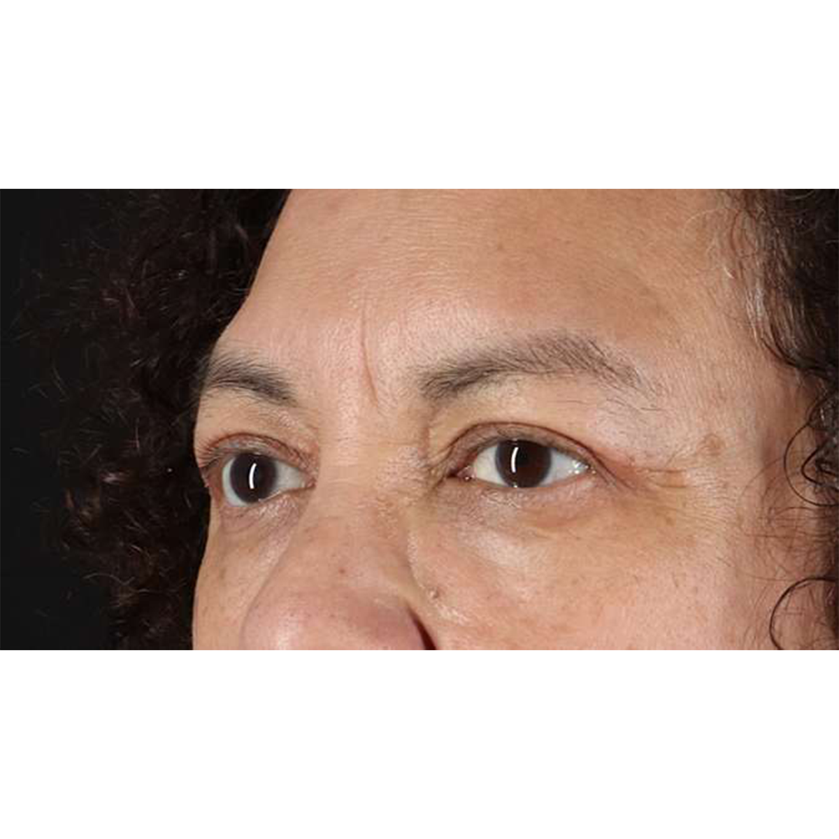 Blepharoplasty (Eyelid Surgery) Before & After Patient #10595