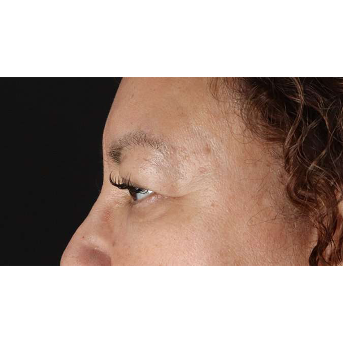 Blepharoplasty (Eyelid Surgery) Before & After Patient #10595