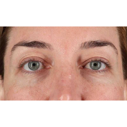 Blepharoplasty (Eyelid Surgery) Before & After Patient #10584