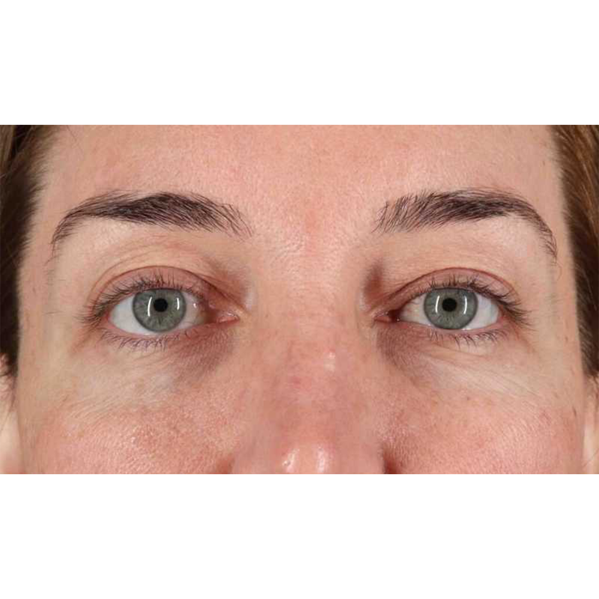 Blepharoplasty (Eyelid Surgery) Before & After Patient #10584