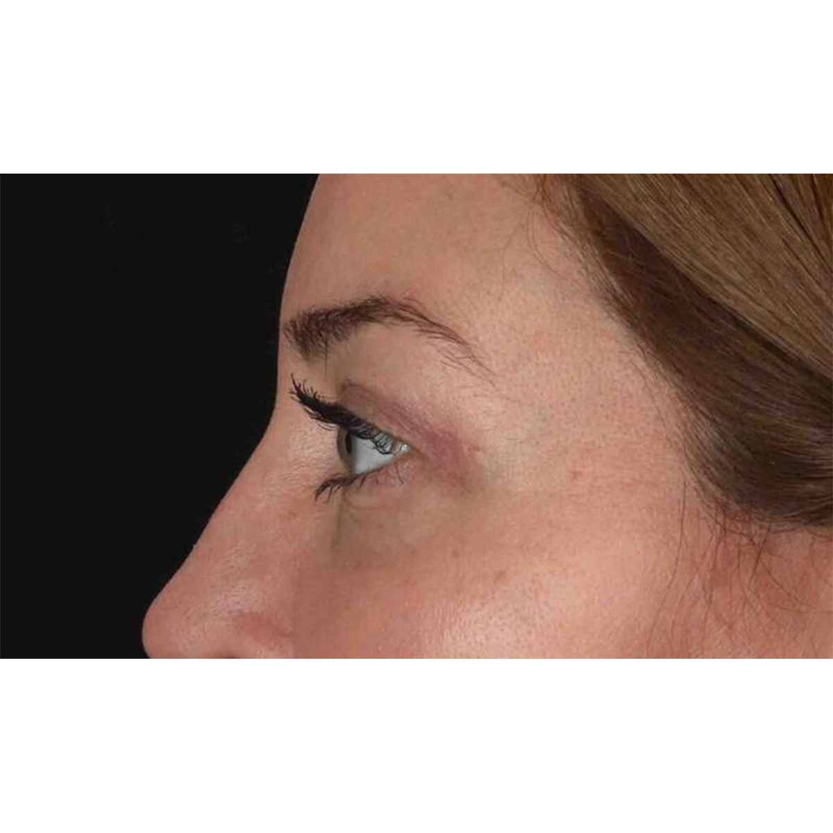 Blepharoplasty (Eyelid Surgery) Before & After Patient #10584