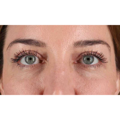 Blepharoplasty (Eyelid Surgery) Before & After Patient #10584