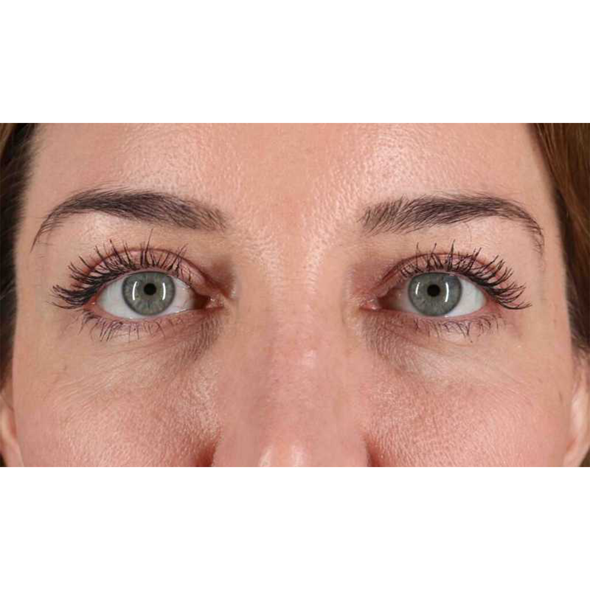 Blepharoplasty (Eyelid Surgery) Before & After Patient #10584