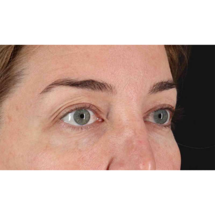 Blepharoplasty (Eyelid Surgery) Before & After Patient #10584