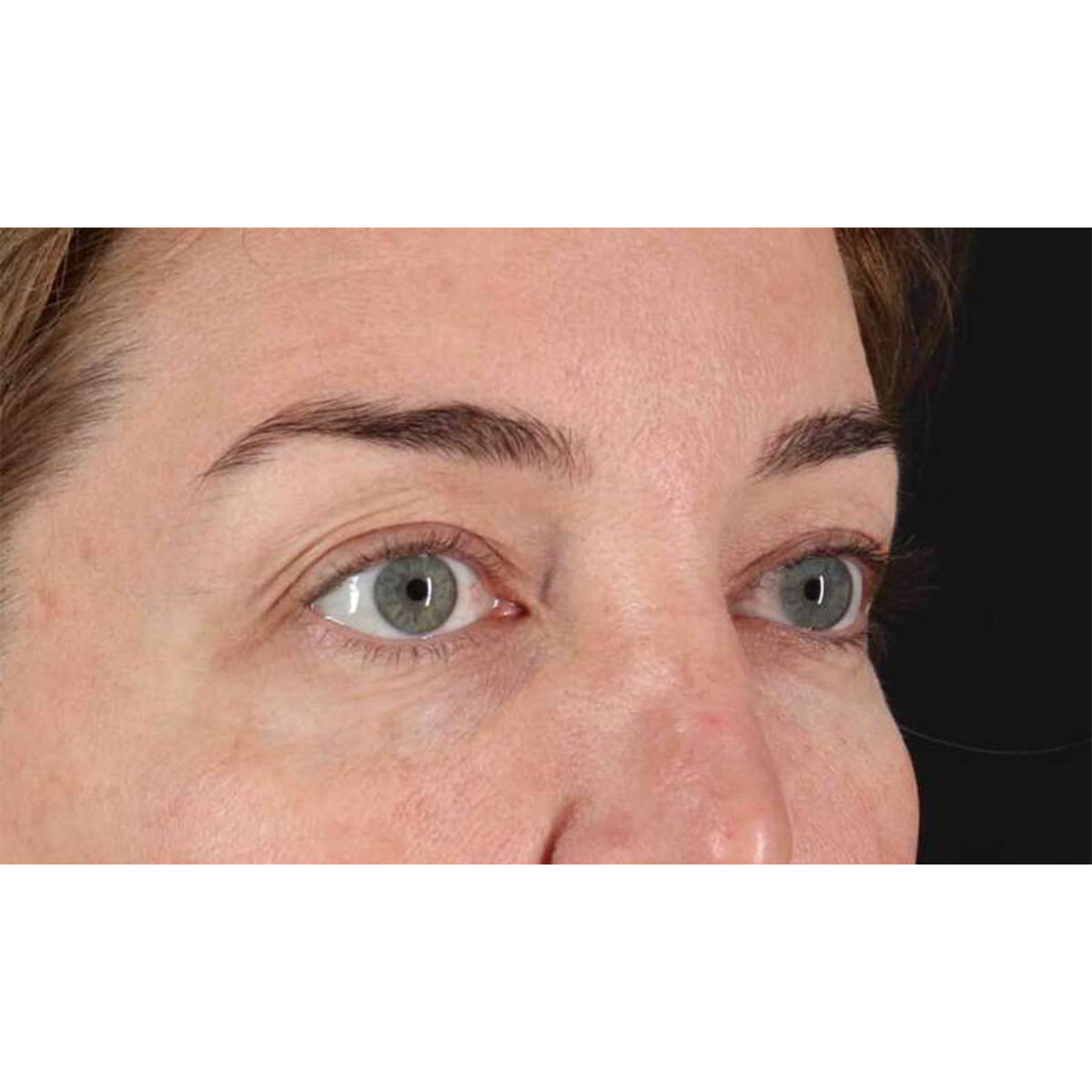 Blepharoplasty (Eyelid Surgery) Before & After Patient #10584