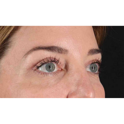 Blepharoplasty (Eyelid Surgery) Before & After Patient #10584