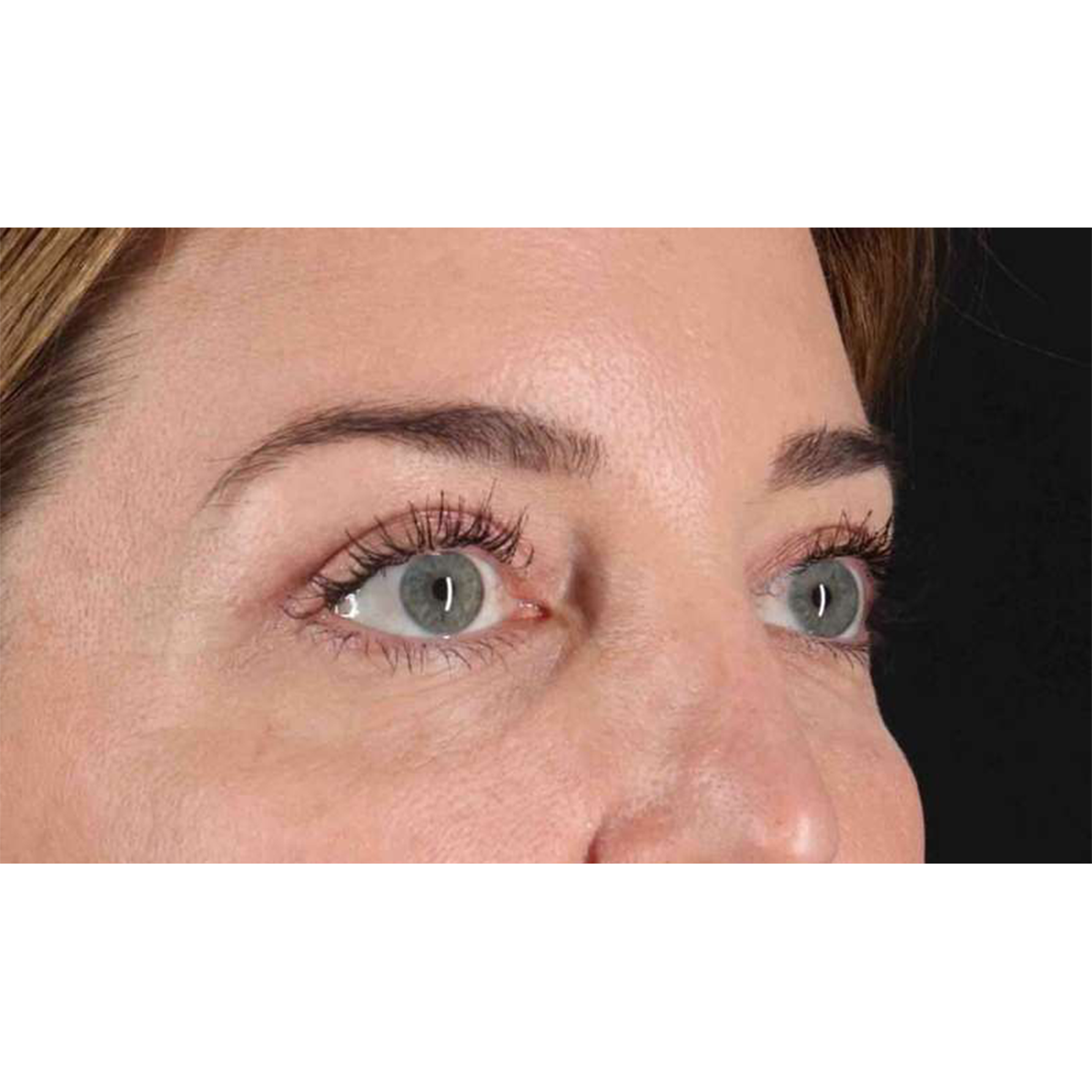Blepharoplasty (Eyelid Surgery) Before & After Patient #10584
